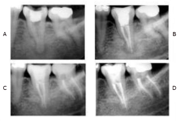 Endodoncia o tratamiento de conductos